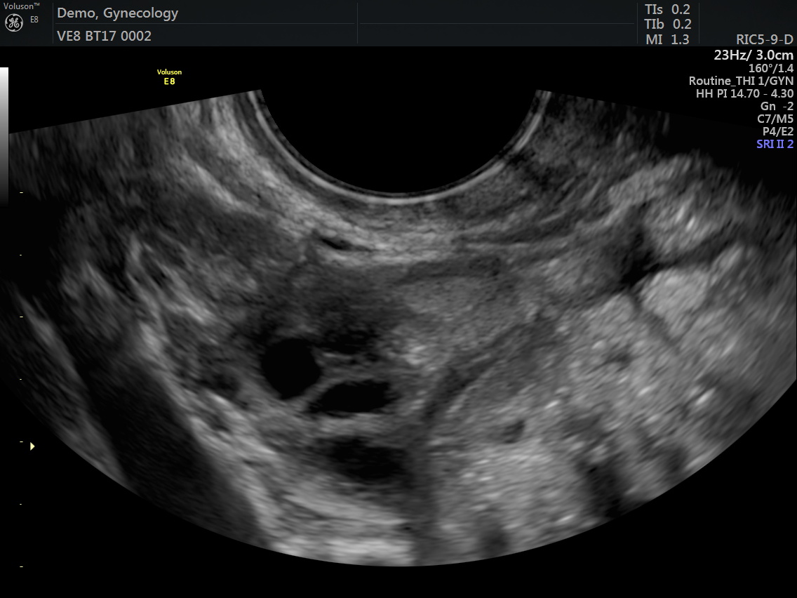 Transvaginal Pelvic Ultrasound - Fisioeuropa